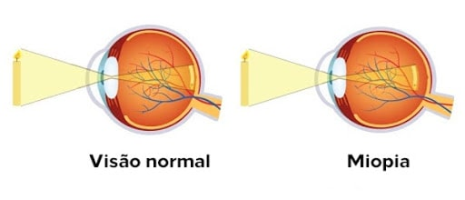 Visão Normal X Miopia