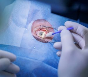 Cirurgia refrativa personalizada para hipermetropia - Dr Visão