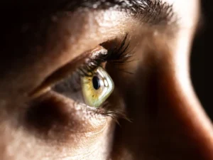 Ceratocone O que é, sintomas e como tratar