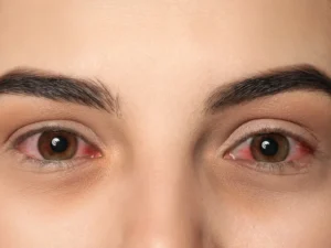 Síndrome do olho seco O que é, sintomas, tratamentos e como tratar