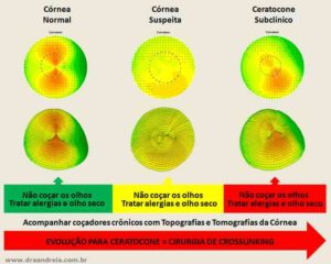 Tratamento do Ceratocone